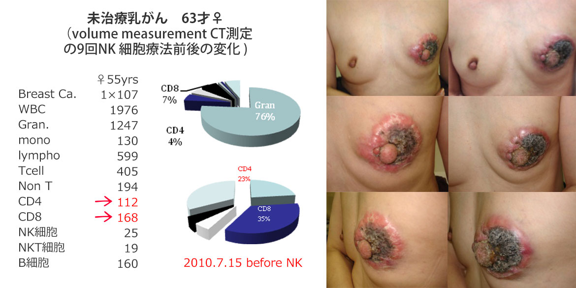 未治療乳がん　63才♀