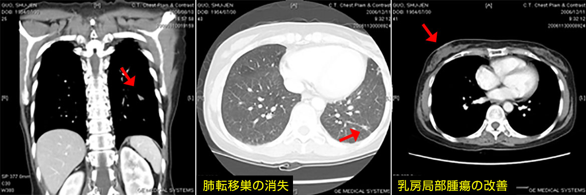 NK細胞療法後 （2006年12月11日）