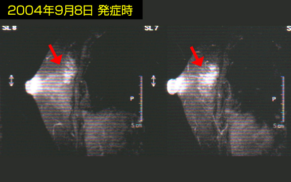 NK細胞療法と他治療法を併用して治療した患者の例