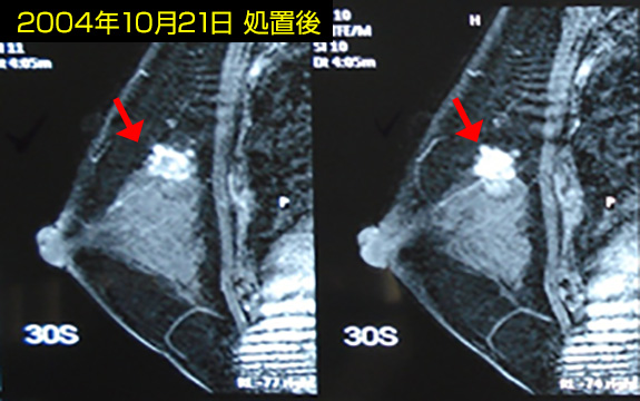 NK細胞療法と他治療法を併用して治療した患者の例