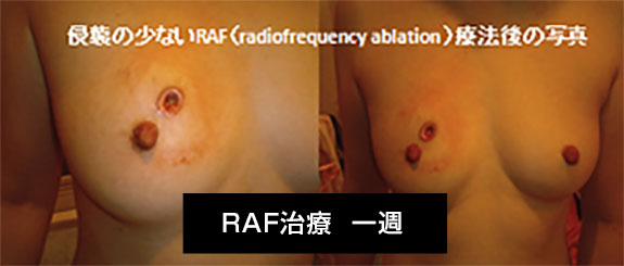 NK細胞療法と他治療法を併用して治療した患者の例