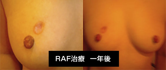 NK細胞療法と他治療法を併用して治療した患者の例