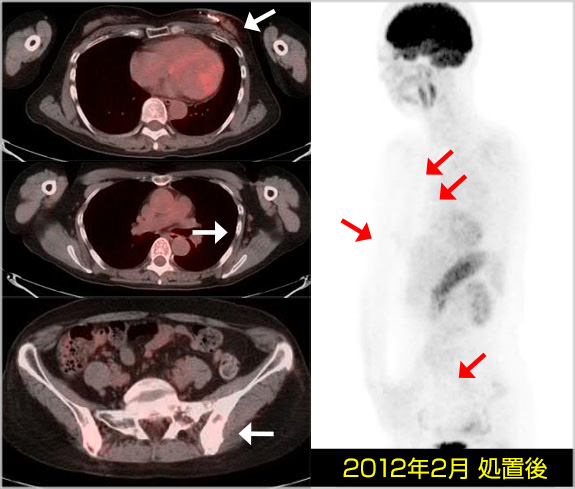 加療処置後（2012年2月）