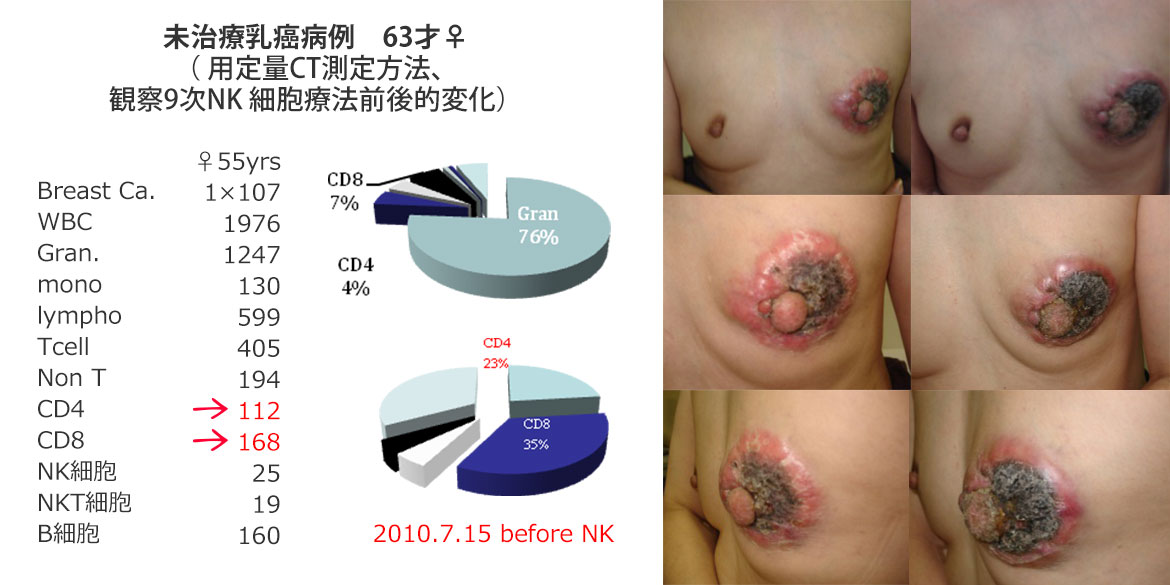 未治療乳癌病例　63才♀