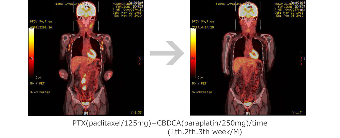 44yrs  F   Ovarian Ca.
