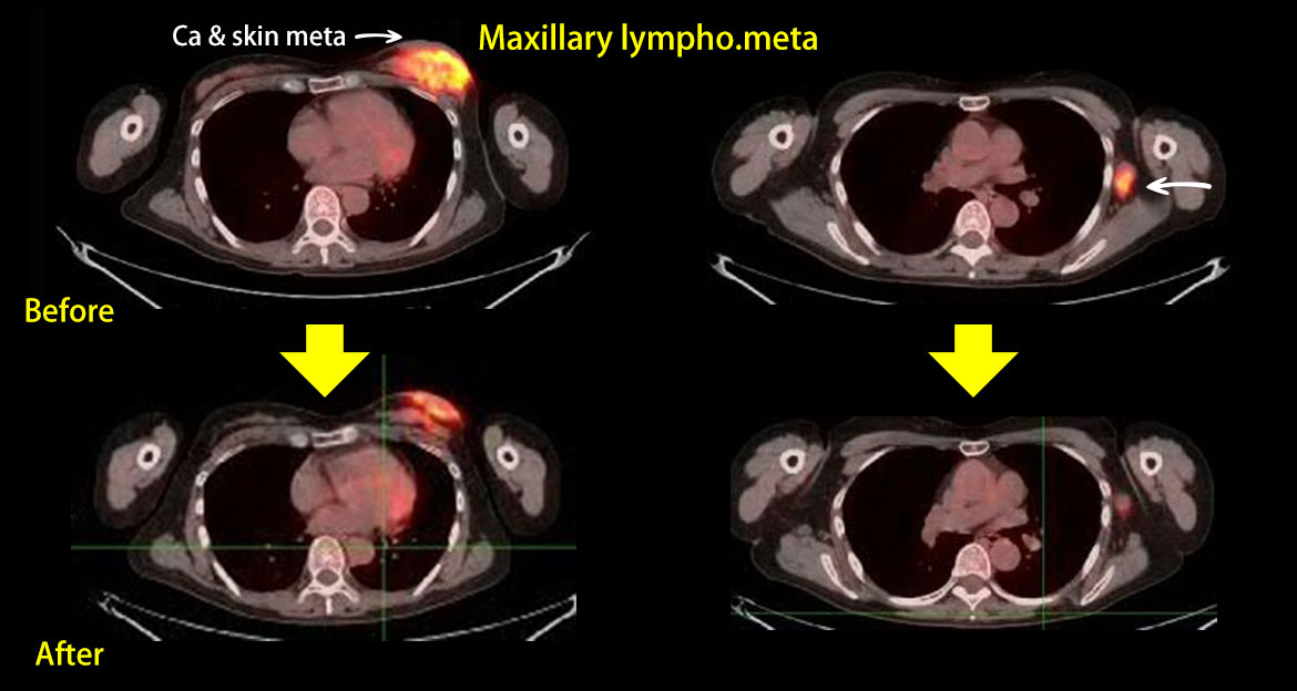 Untreated progressing  Breast Ca.(without any treatment)　55yrs.♀