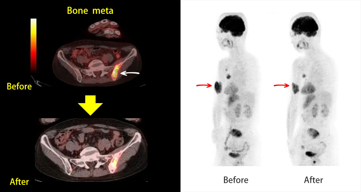 Untreated progressing  Breast Ca.(without any treatment)　55yrs.♀