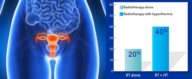 12 year Overall of Ovarian cancer Survival