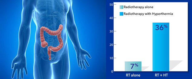 5 yr Survival Rectal Cancer with Radiation